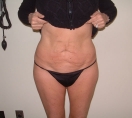 atlanta liposuction results