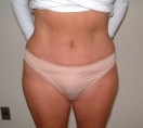 atlanta liposuction results